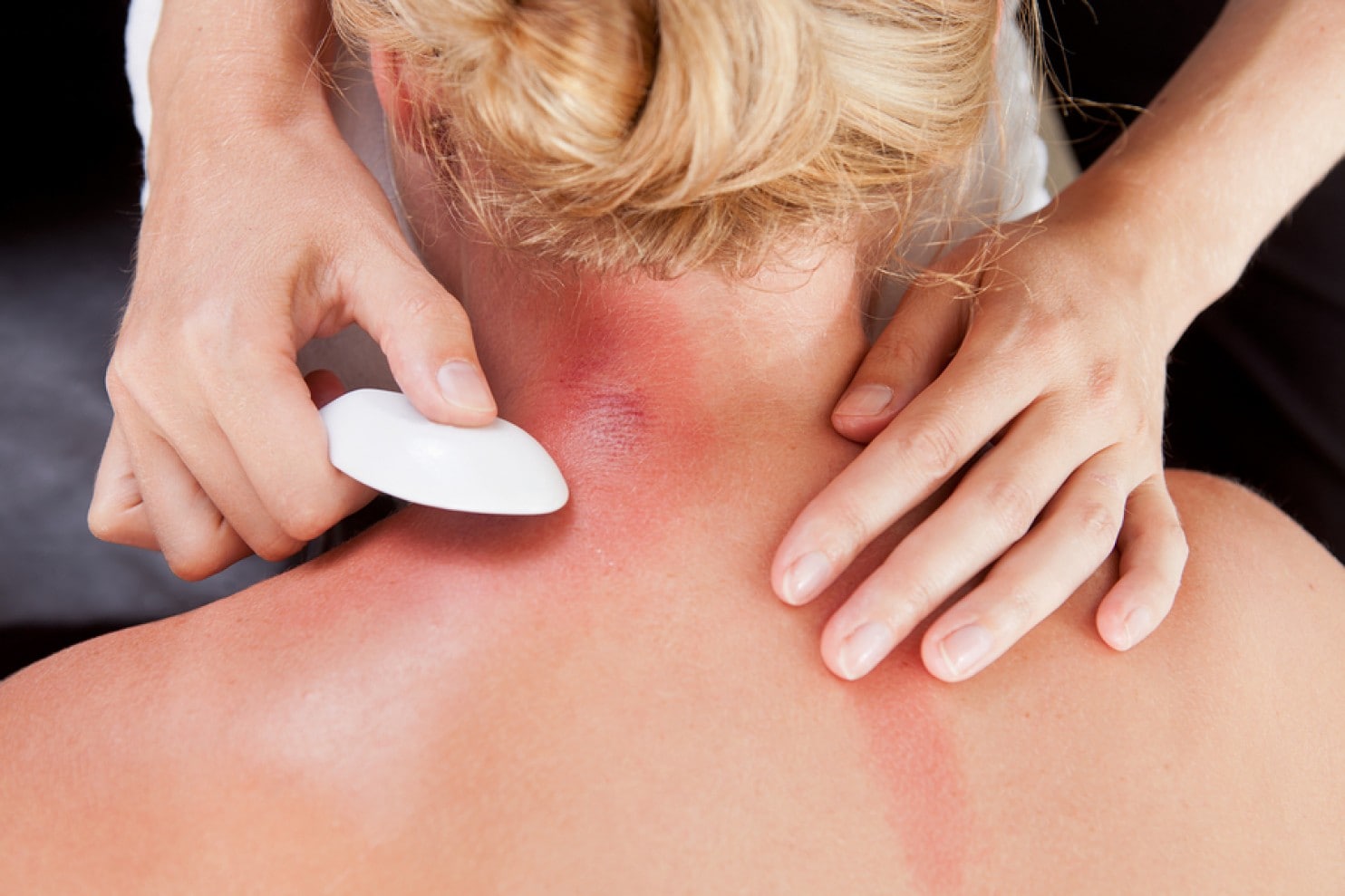 Gua Sha Scraping Bruises