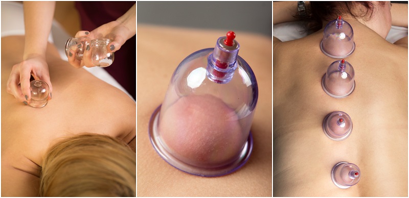 Benefits Of Cupping Therapy