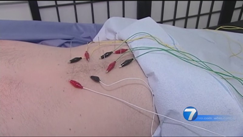 Ohio Medicaid Covers Acupuncture