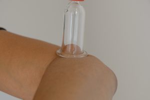 cupping therapy